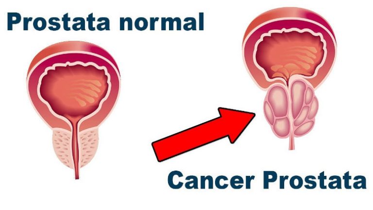 cancer-de-prostata