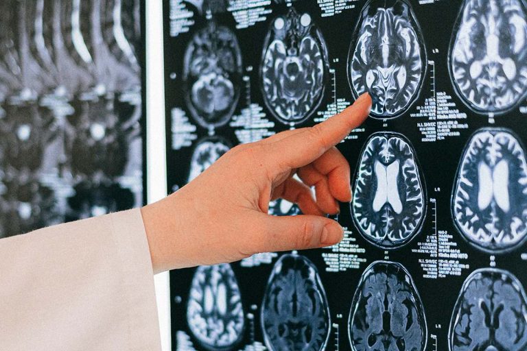tumor cerebral