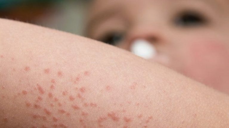 dermattitis