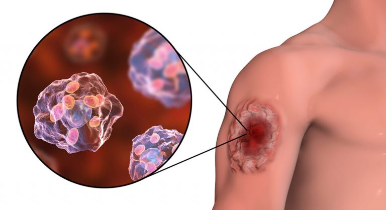 Leishmaniasis-