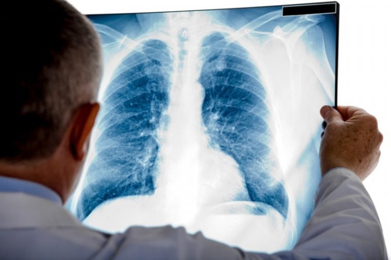 pulmones